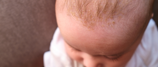 What is Cradle Cap? And How do I Get Rid of it?